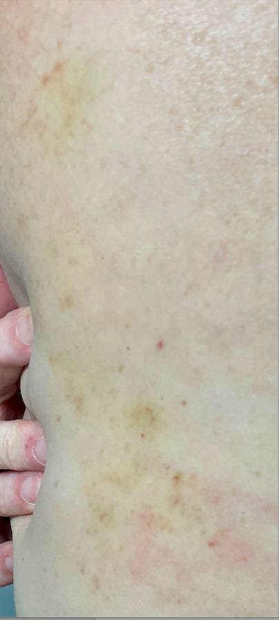 Rash on back due to covid19 vaccine death jab