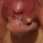 Infected pimple on nose
